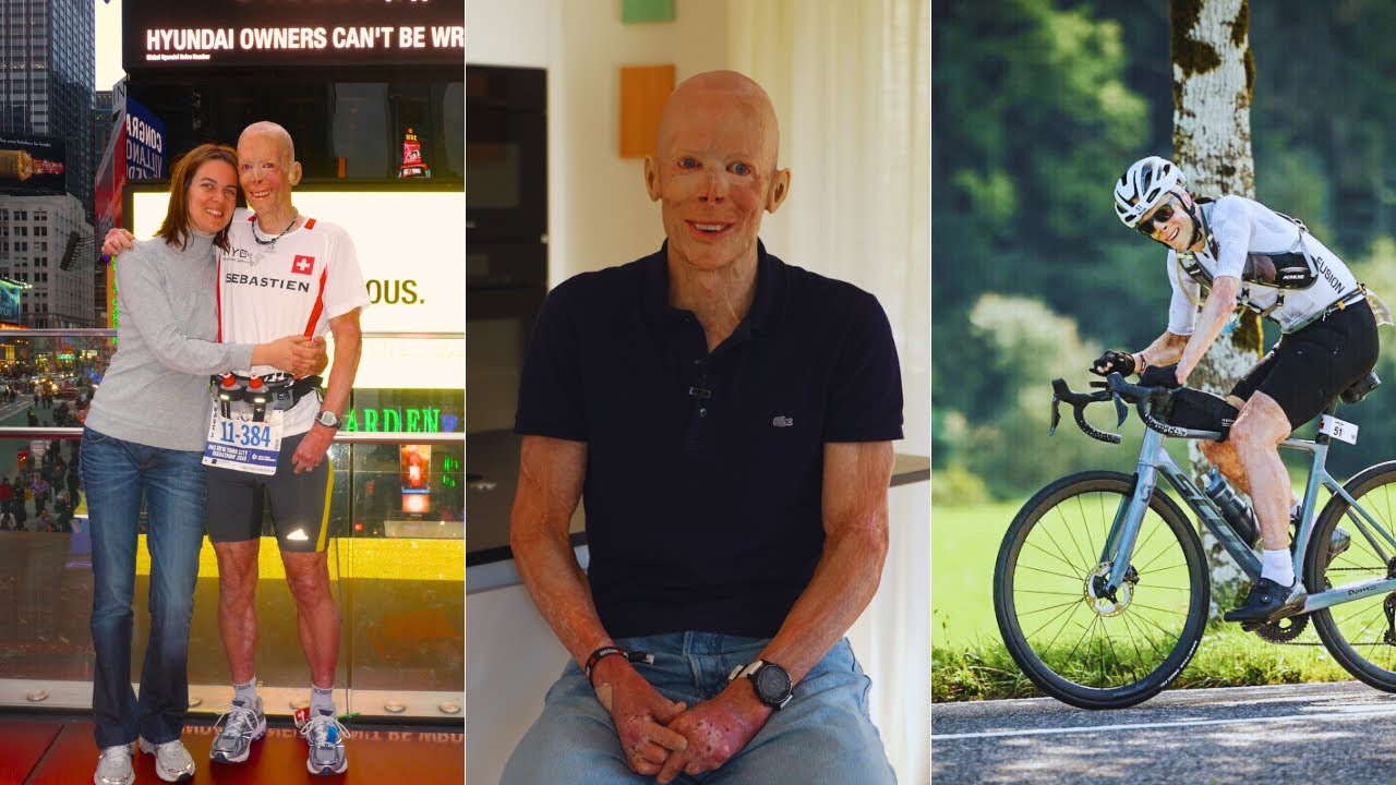 Sébastien Maillard, 48 ans, partage son expérience de grand brûlé